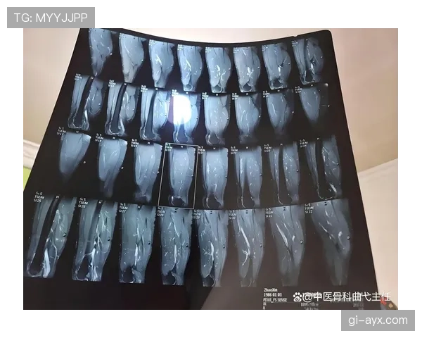 佩德里股四头肌撕裂